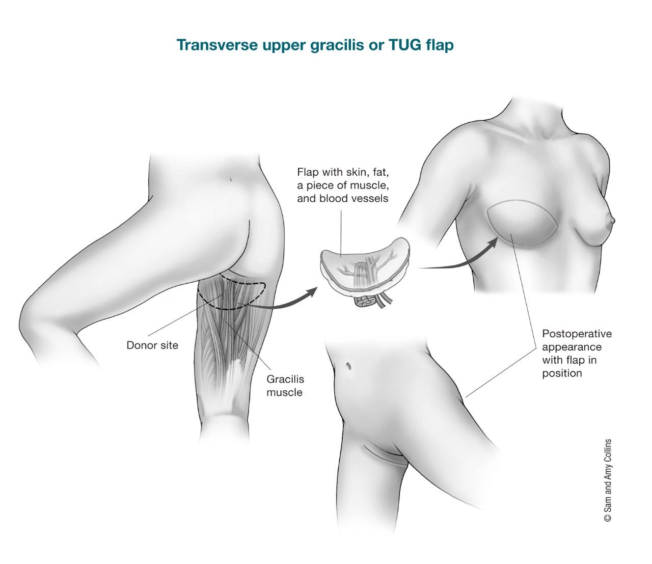 illustration showing the donor site (gracilis muscle), the flap with skin, fat, a piece of muscle and blood vessels and the postoperative appearance with flap in position