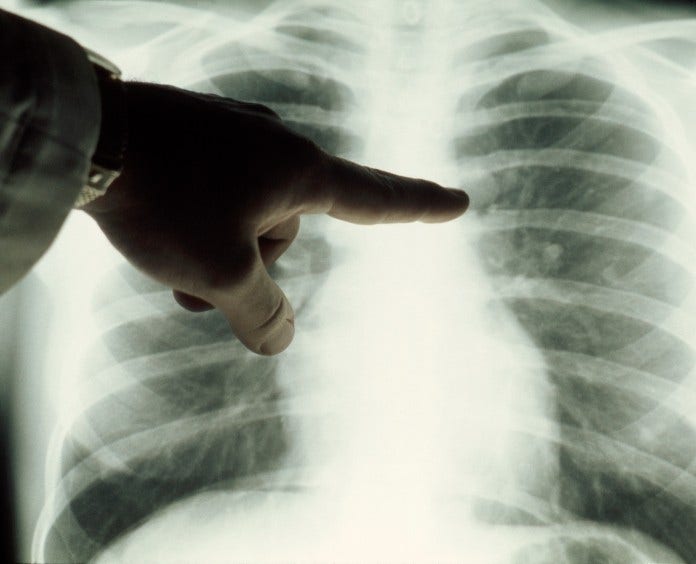 A doctor's hand points to a chest x-ray