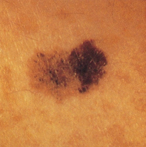 Photo of mole showing asymmetry, border irregularity, and color