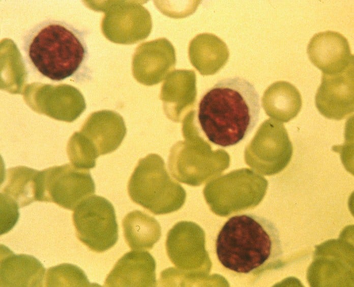 A histological slide of hairy cell leukemia