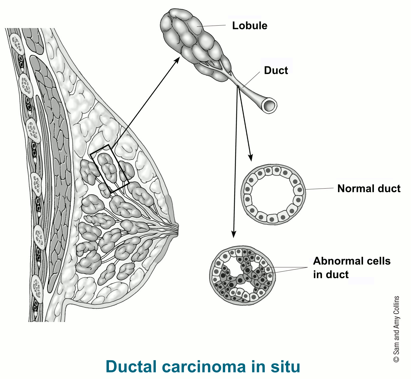 illustration showing details of ductal carcinoma in situ including lobule, duct, normal duct and abnormal cells in duct