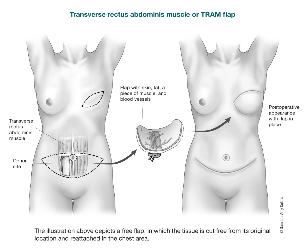 illustration depicting a free flap in which the tissue is cut free from its original location and reattached in the chest area