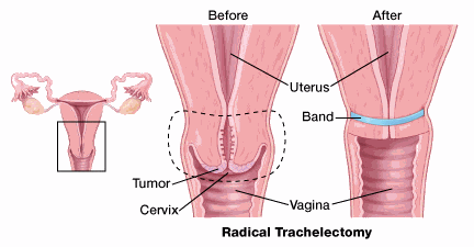 illustration showing the before and after of a radical trachelectomy procedure