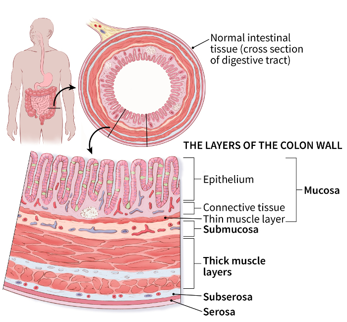 illustration showing a cross section of the digestive tract (normal intestinal tissue) and details of the layers of the colon wall (including the mucosa (epithelium, connective tissue, thin muscle layer), submucosa, thick muscle layers, subserosa and serosa)