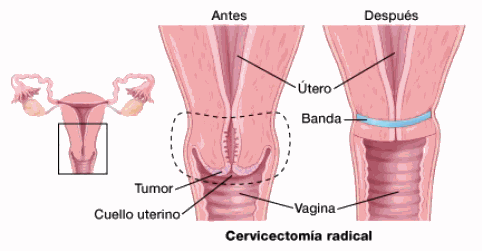 radical trachelectomy Spanish