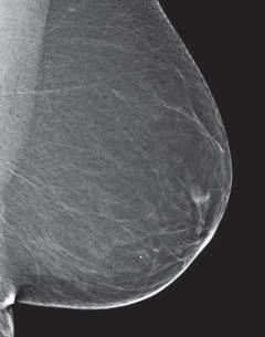 mammogram image showing a breast that is almost all fatty tissue