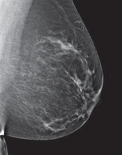 mammogram image showing a breast that has scattered areas of dense glandular and fibrous tissue